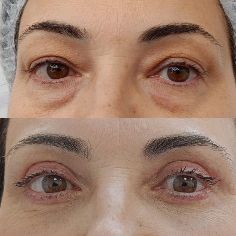 Blefaroplastie1