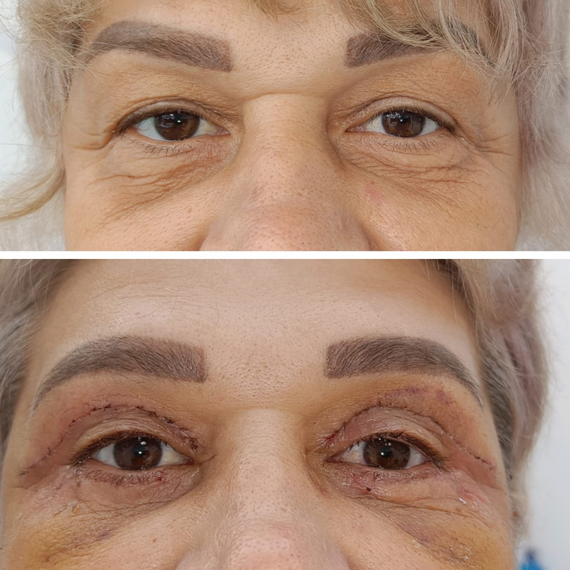 Blefaroplastie11