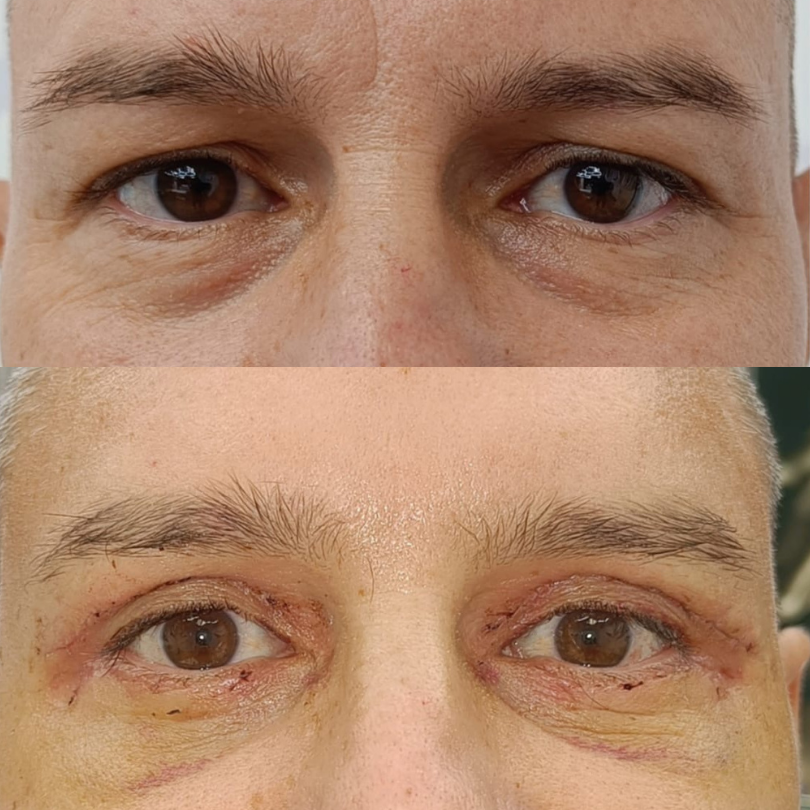Blefaroplastie10