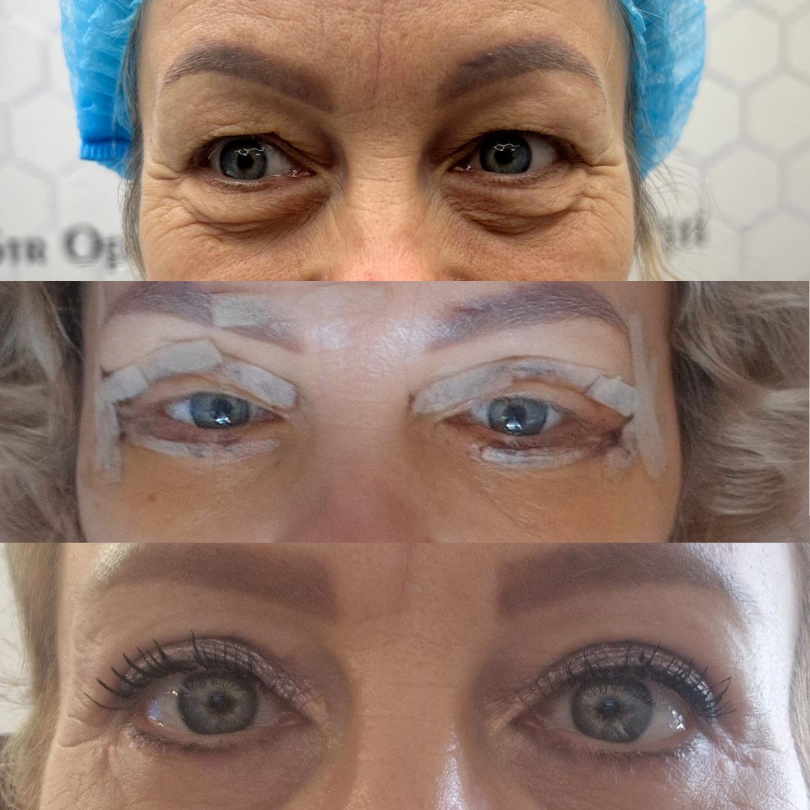 Blefaroplastie12