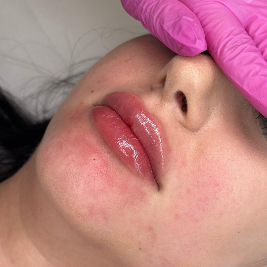 acid hialuronic injectabil