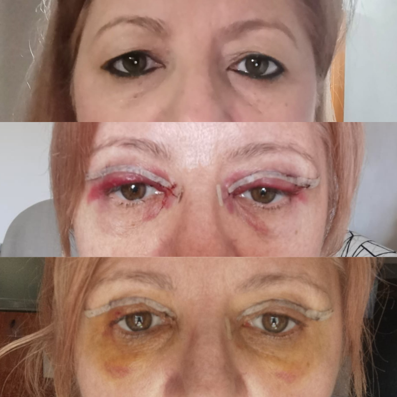 Blefaroplastie13