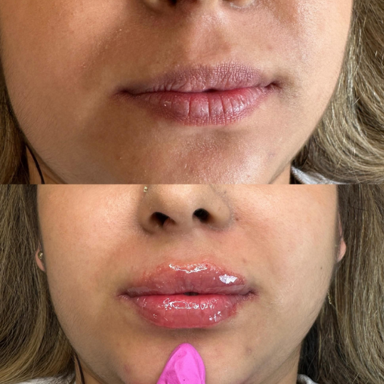 the ordinary acid hialuronic