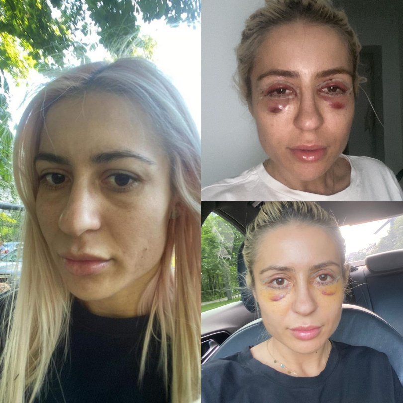 Blefaroplastie15