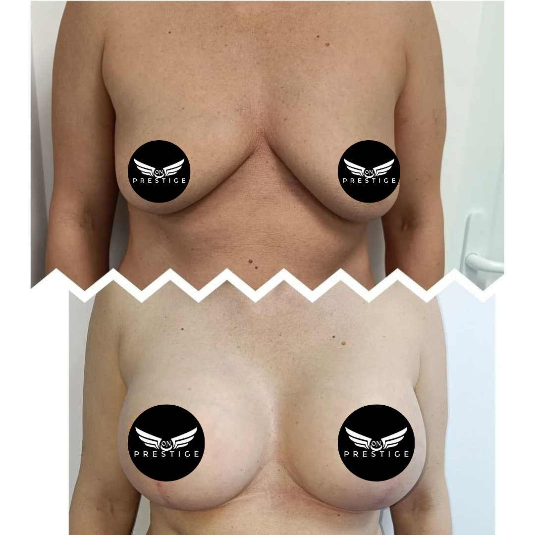 rezultat4 implant mamar si lifting inainte si dupa