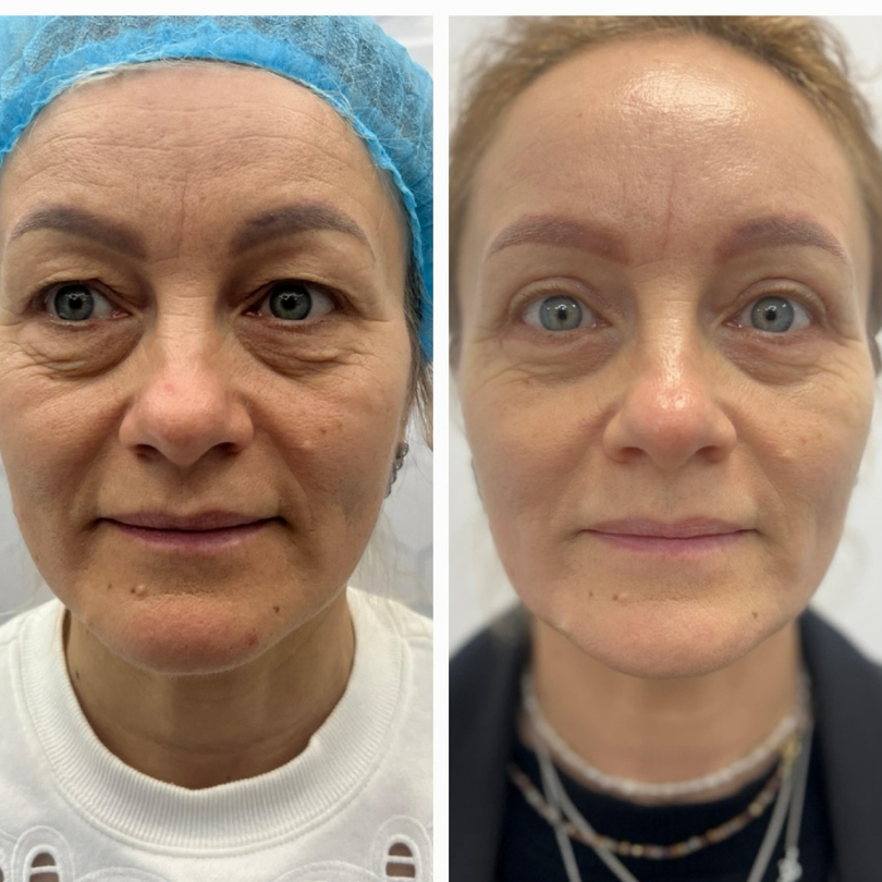 Blefaroplastie3