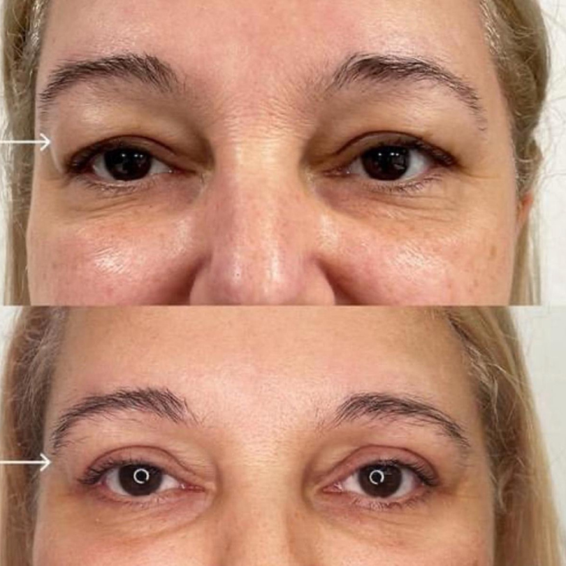Blefaroplastie14