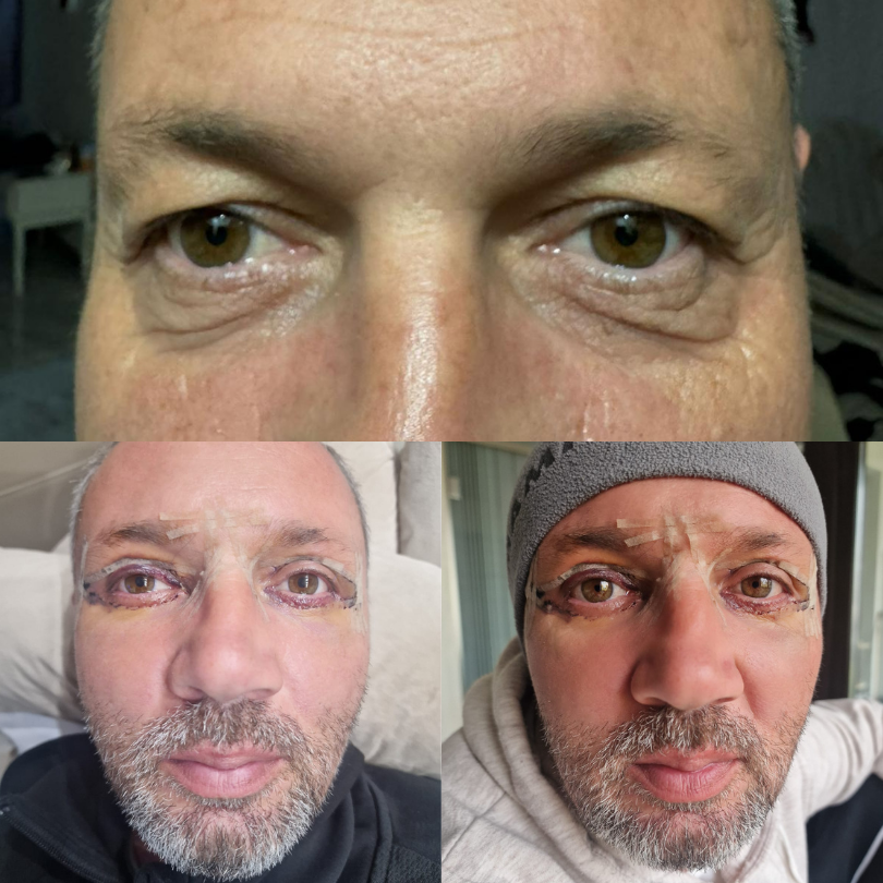 Blefaroplastie16