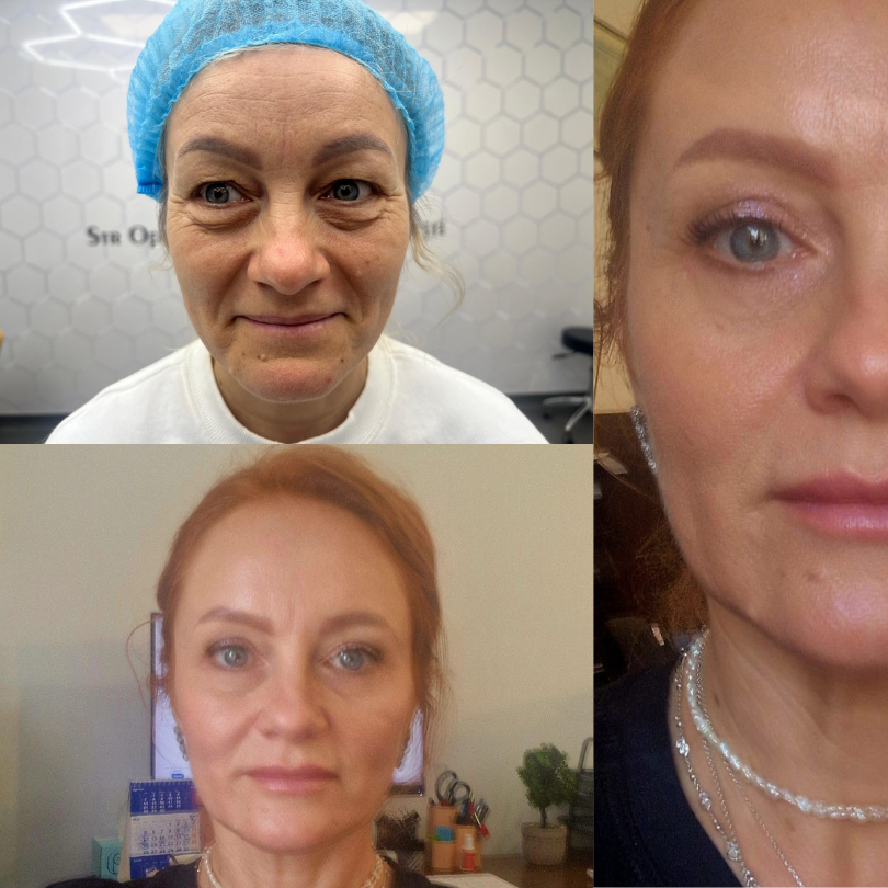 Blefaroplastie17