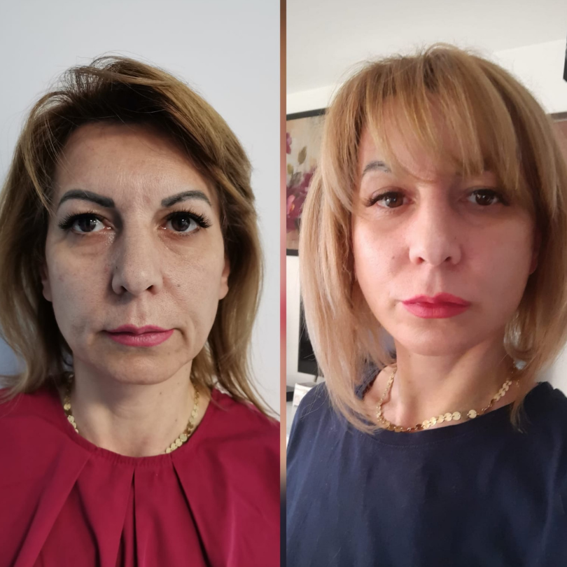 Blefaroplastie24