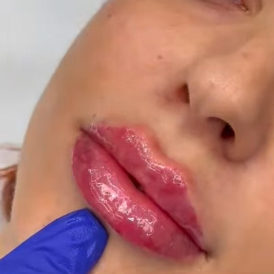 juvederm ultra 3