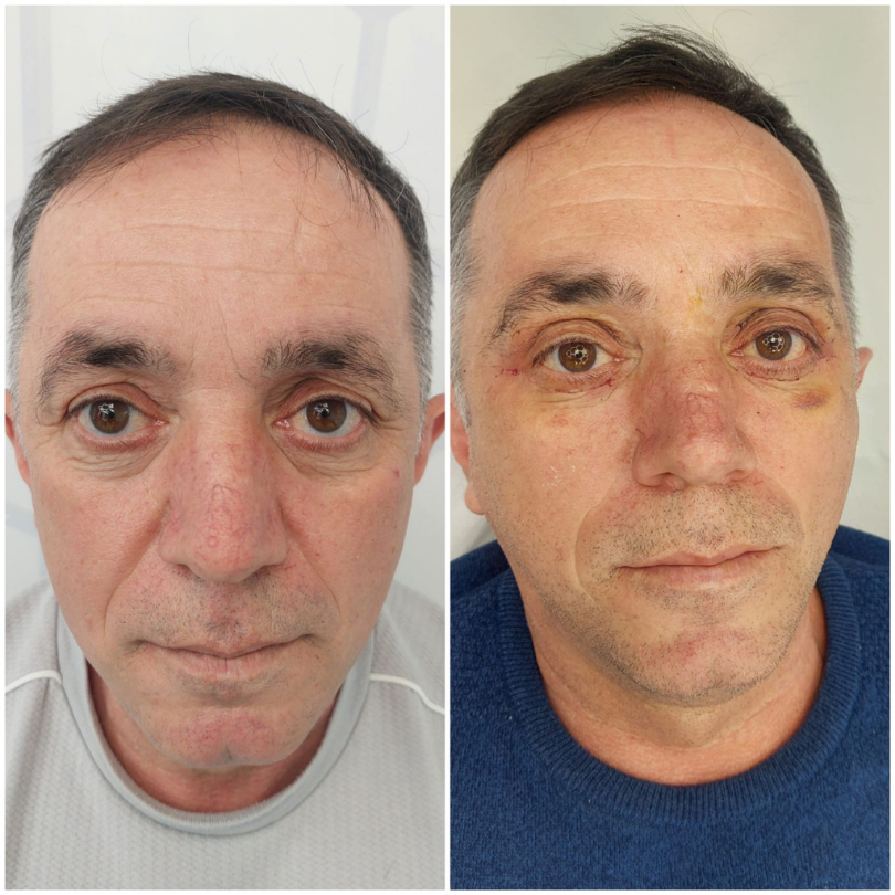 Blefaroplastie2