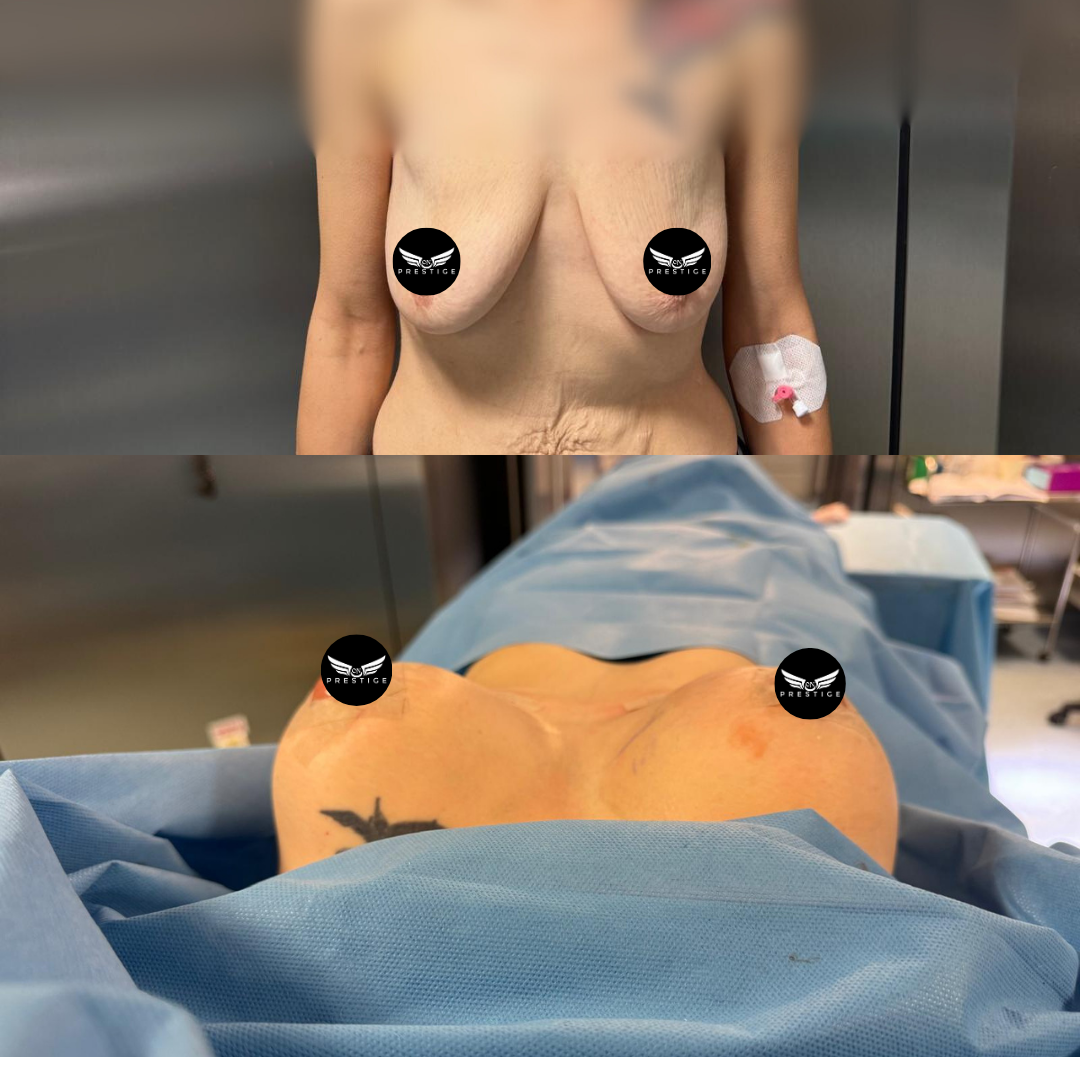 rezultat1 implant mamar si lifting inainte si dupa