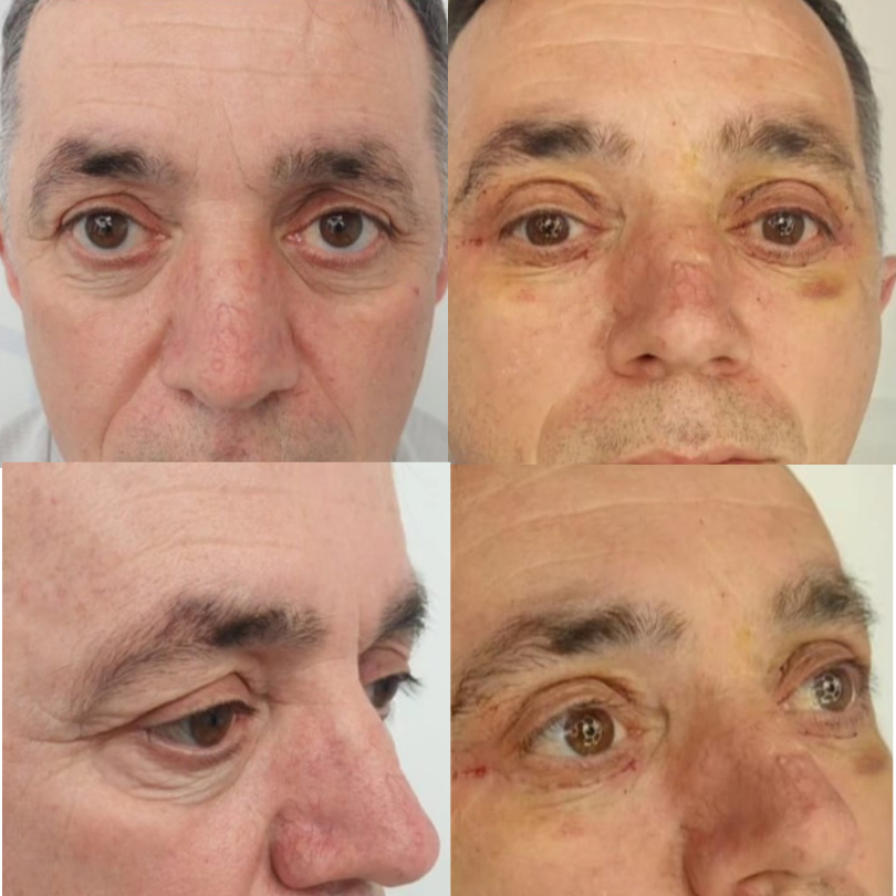 Blefaroplastie4