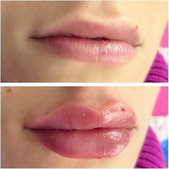 acid hialuronic premium cluj