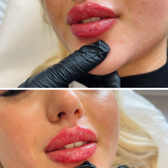 acid before and after