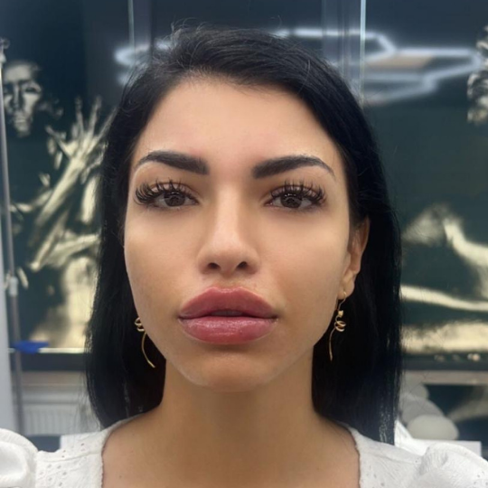 acid hialuronic Prestige bucuresti