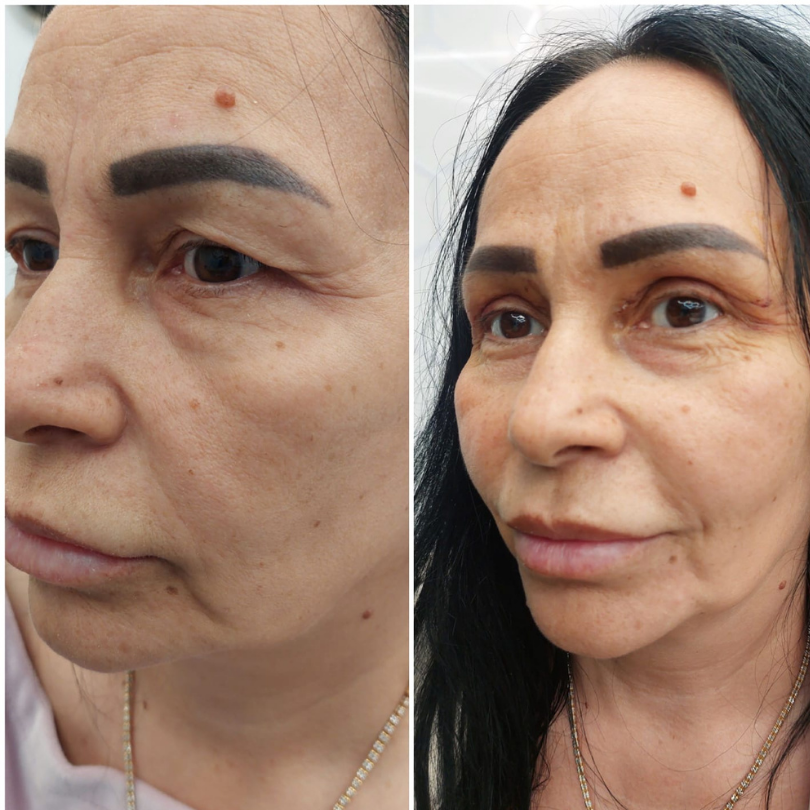 Blefaroplastie6