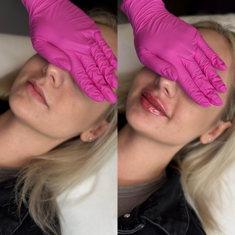 acid hialuronic Stylage