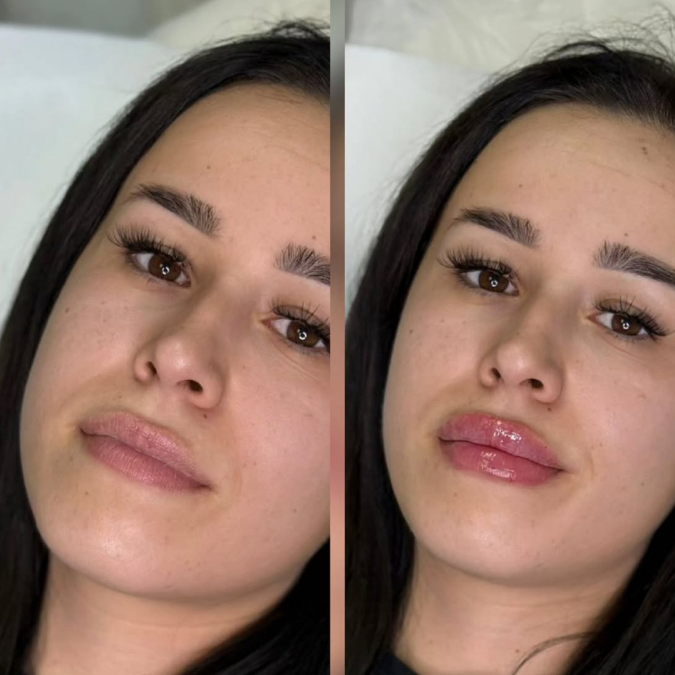 acid hialuronic Cluj