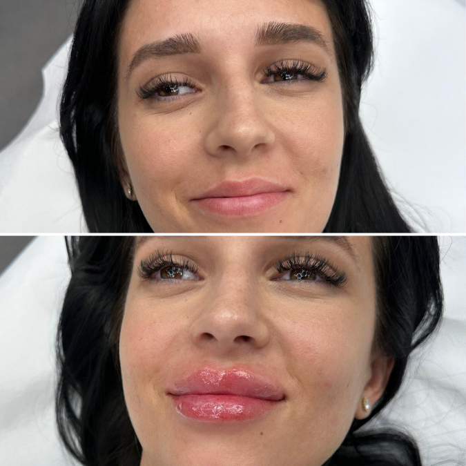 acid hialuronic Bucuresti