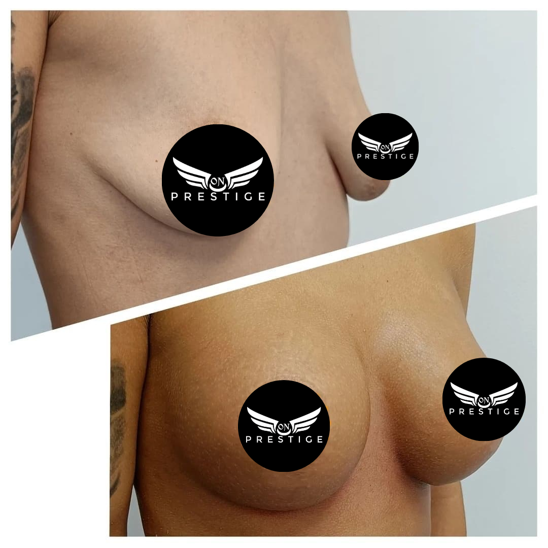 rezultat4 implant mamar inainte si dupa