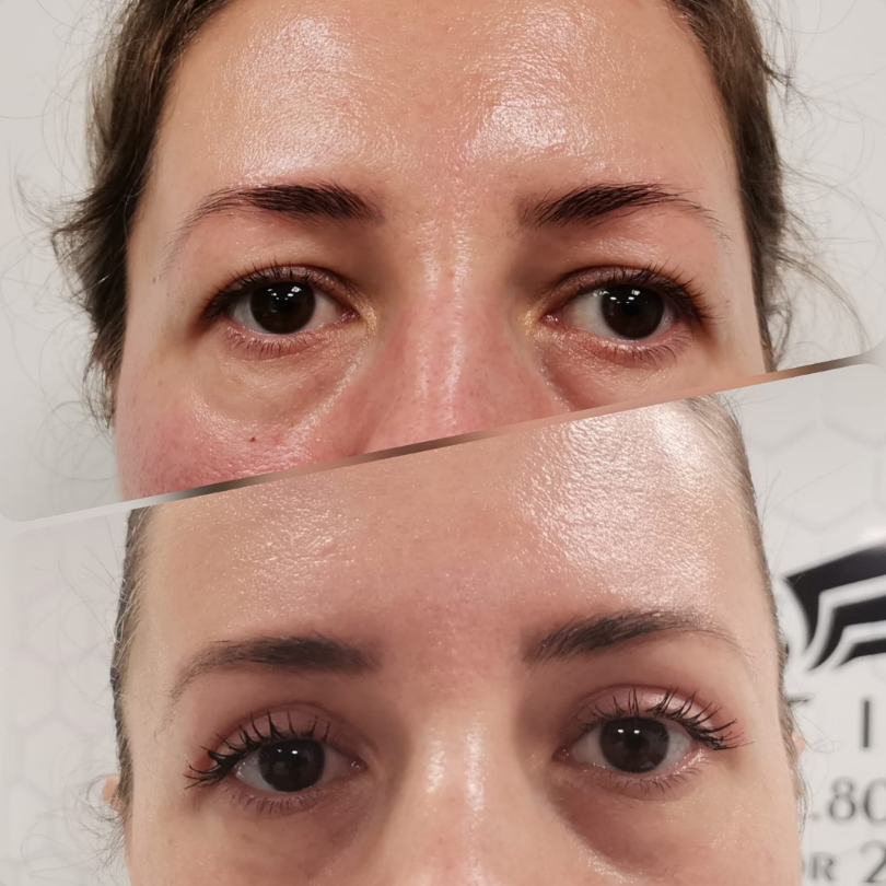 Blefaroplastie8