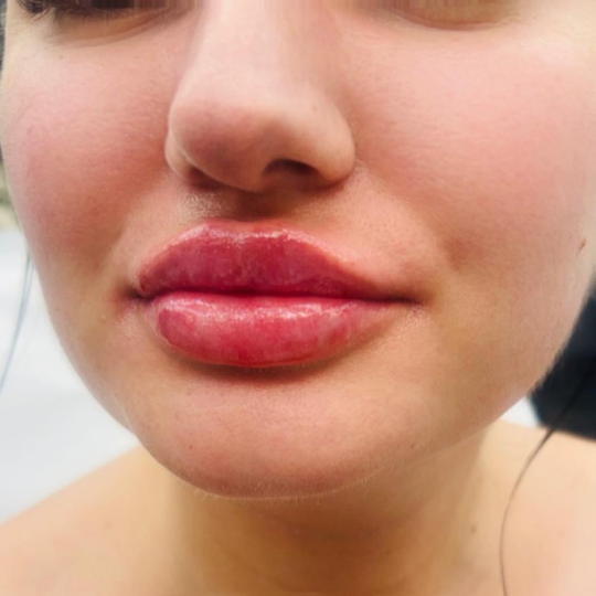 juvederm