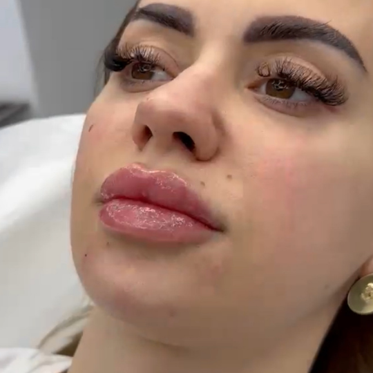 injectare acid hialuronic