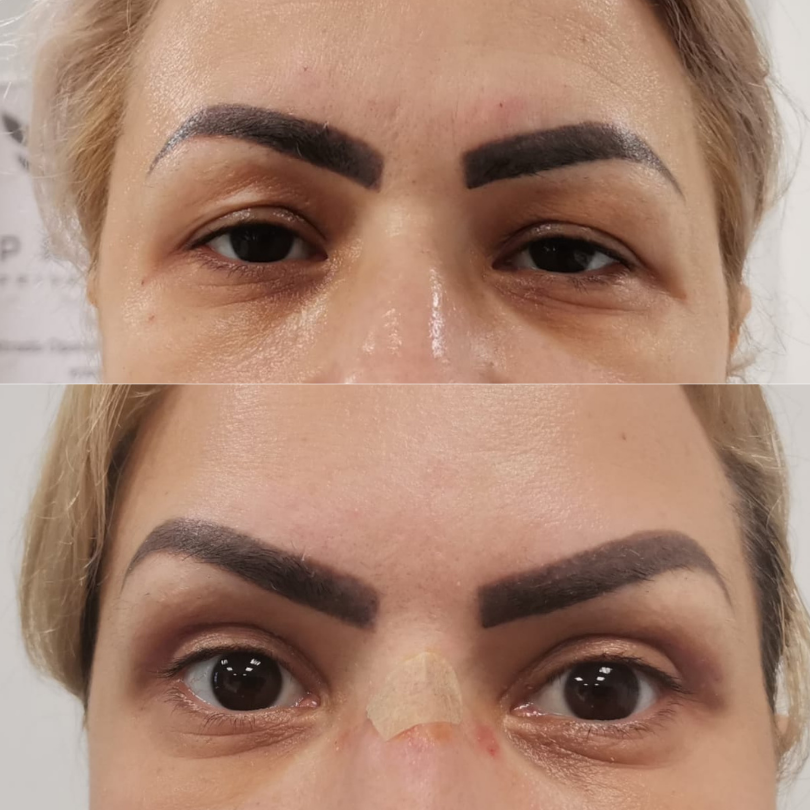 Blefaroplastie7