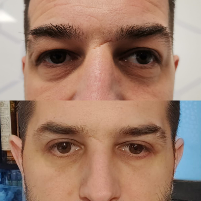 Blefaroplastie9